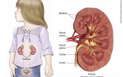 What to know about childhood kidney cancer